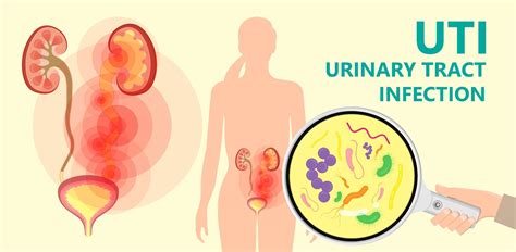 sore uei|Urinary tract infection (lower)